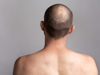 Haartransplantation – der Spenderbereich