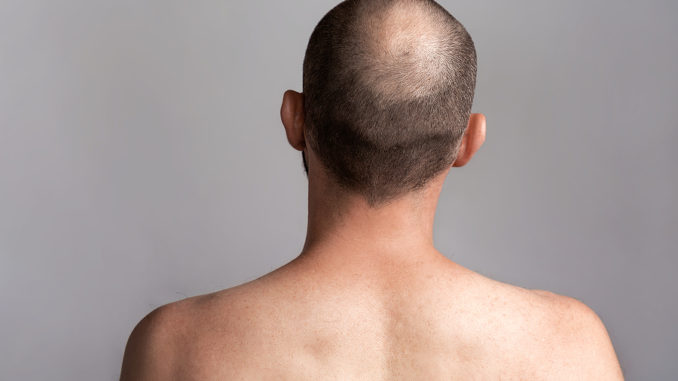 Haartransplantation – der Spenderbereich