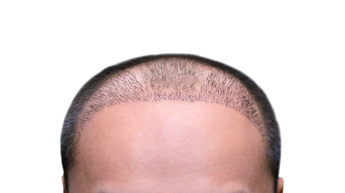 Saphire FUE Haartransplantation Methode