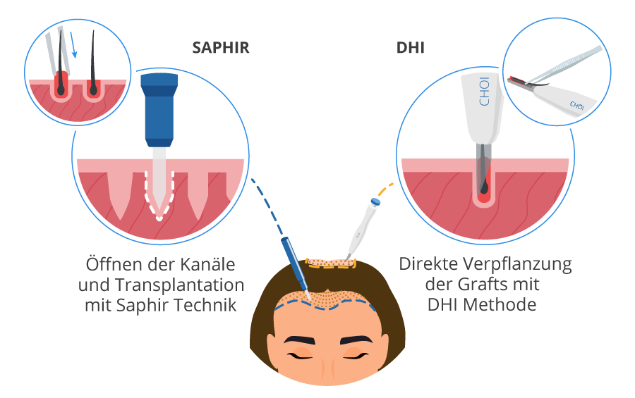 Grafik-Verpflanzen-mit-SDHI-Haartransplantation