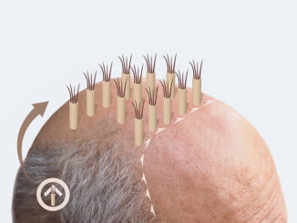 Wie funktioniert eine Haartransplantation